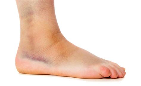 A Sprained Ankle The Facts And How To Heal Fully And Fast