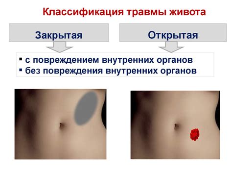 Первая помощь при травме живота - презентация онлайн