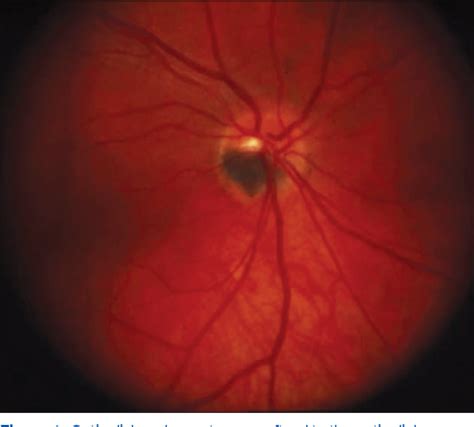 Figure 1 From Melanocytoma Of The Optic Disk A Review Semantic Scholar