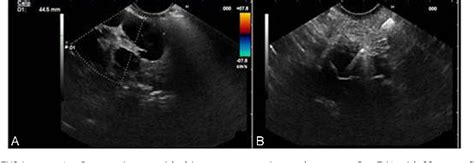 Figure 1 From Cystic Pancreatic Lymphangioma Diagnostic Role Of