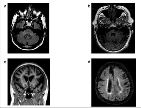 MR Images Showing Characteristic Findings In FXTAS 1a Axial FLAIR MCP