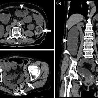 Resected specimen. A fecal mass (arrow) obstructed the descending... | Download Scientific Diagram