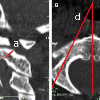 Anatomical Localization Of The Pars Interarticularis And The Pedicle