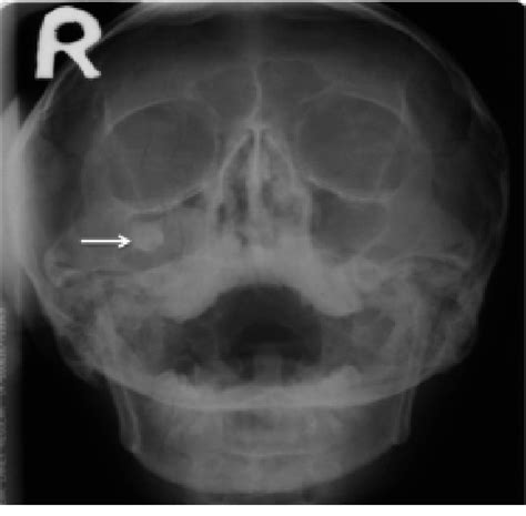 Figure From Keratocystic Odontogenic Tumor Invading The Right