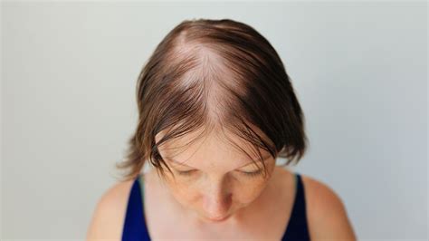 Alopecia saiba 7 sinais que indicam o surgimento da doença