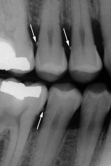 Subgingival Calculus