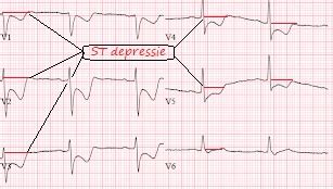 E Learning Levensbedreigende ECG Afwijkingen Hyperacute T Golven