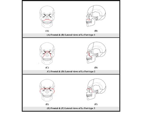 Types of Le Fort fractures. | Download Scientific Diagram