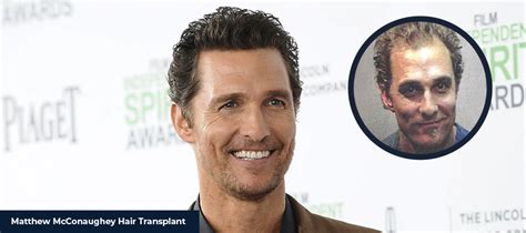 Matthew Mcconaughey Hair Transplant Smile Hair Clinic