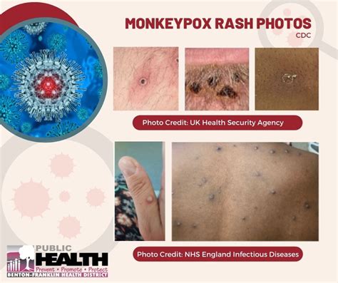 Monkeypox Benton Franklin Health District