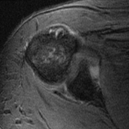 Reverse Bankart Lesion Radiology Reference Article Radiopaedia Org