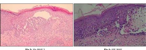 Figure From A Clinico Pathological Study On Pemphigus Vulgaris With