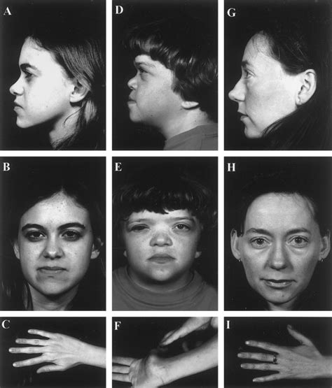 Variation In The Vitreous Phenotype Of Stickler Syndrome Can Be Caused