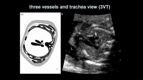 FETAL ECHO THREE VESSEL TRACHEA VIEW 3VT Dr Ahmed Esawy YouTube