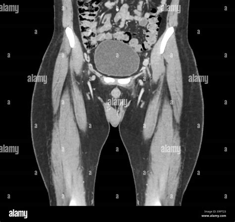 Computed Tomography Ct Scan Of The Healthy Full Bladder Oval Of A