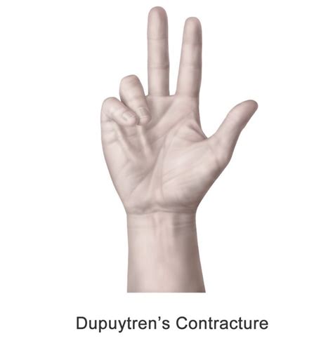 Dupuytrens Contracture