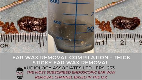 Ear Wax Removal Compilation Thick Sticky Ear Wax Removal Ep 233 Youtube