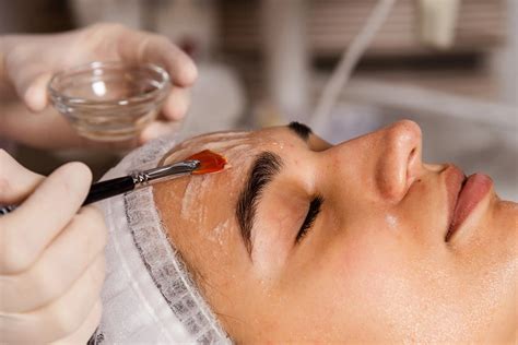 Chemical Peel For Melasma