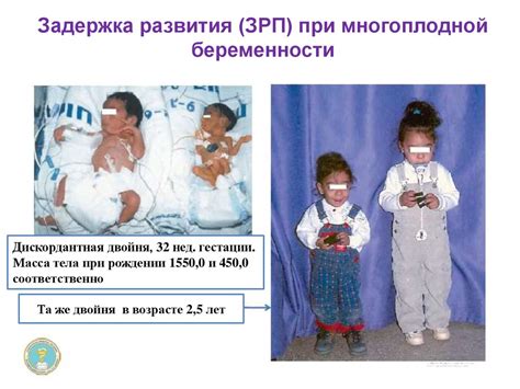 Многоплодная беременность. Близнецы - презентация онлайн