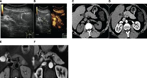 Frontiers The Imaging Features Of Ectopic Spleen Which Modality Is More Consistent A Cases