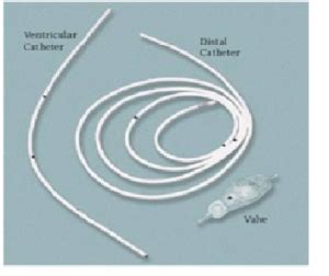 Ventriculo Peritoneal VP Shunt LithosMed