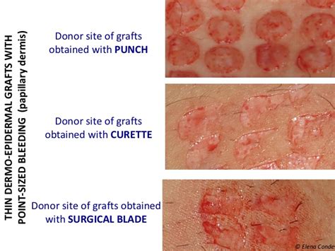 Skin Graft Healing Timeline - Infoupdate.org