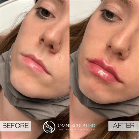 Lip Injections Before And Afters OMNI SCULPT MD Dallas Texas