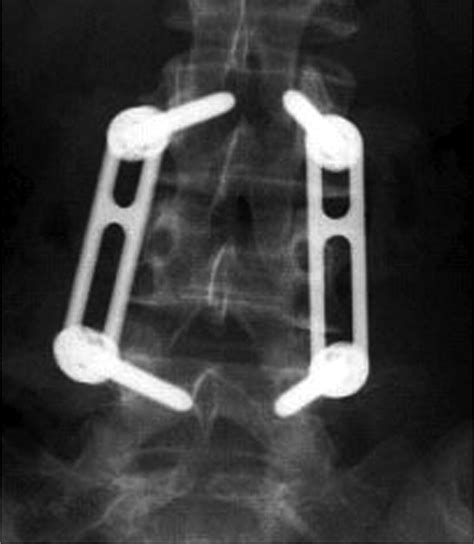 Lumbar Spine Fusion And Stabilization Hardware Techniques And