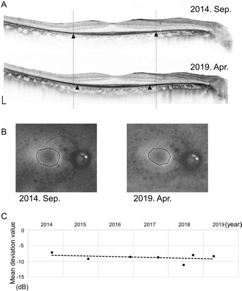 Progression Of Retinitis Pigmentosa On Static Perimetry Optical