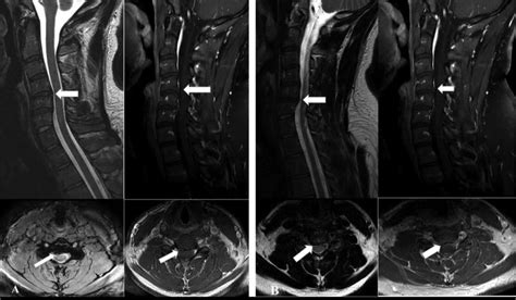 Longitudinal Assessment Of Annular Fissures Of The Cervical Spine