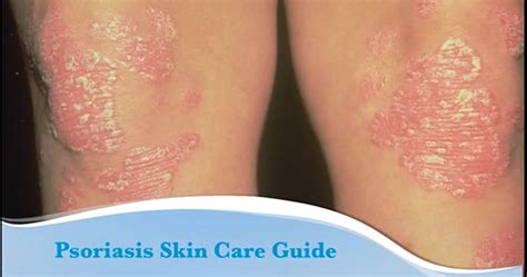 [VIDEO] Skin Care Tips for Psoriasis