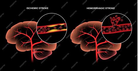 Premium Vector Brain Stroke Ishemic And Hemorrhagic