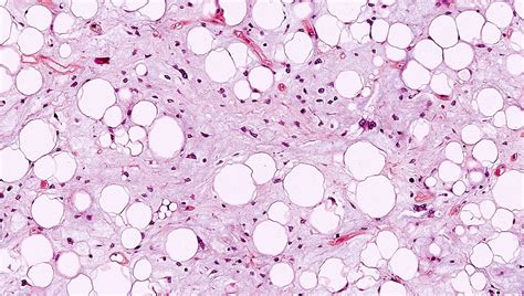 Pathology Outlines Myxoid Pleomorphic Liposarcoma