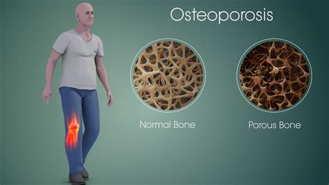 Osteoporosis Amersham Chiropractic Clinic Osteoporosis