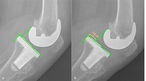 Aflojamiento de prótesis rodilla Dr Josué Calderón Gamba