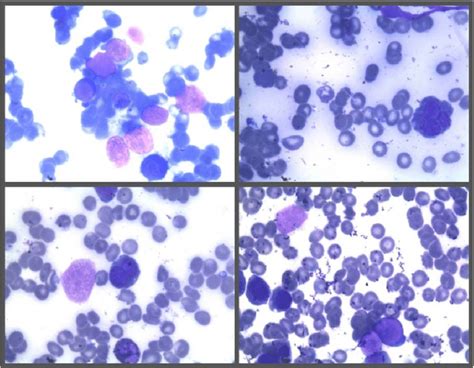 Bone Marrow Aspiration Smear Study Of A Patient Aged Years Who