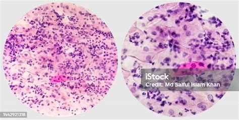 Paps Smear Photo Collage Of Two Microscopic Image Of Pap Smear Showing Inflammatory Smear With