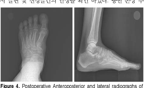 [pdf] Avulsion Fracture Of Medial Cuneiform By Tibialis Anterior Tendon