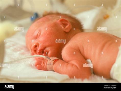 A Premature Baby In A Special Care Unit This Baby Is Covered With Fine