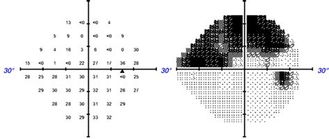 Example Of A 24 2 Hfa Sita Standard Visual Field Test Result Of A