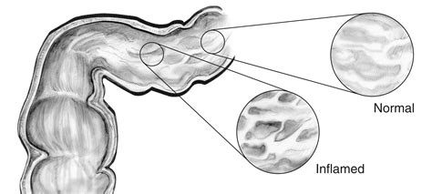 The Lining Of The Gi Tract An Inset Image Shows Normal Tissue And