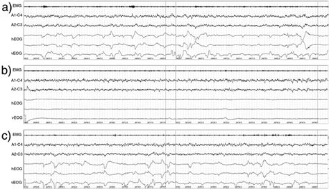 Example Polysomnographic Psg Record Showing Rem Eye Movements A