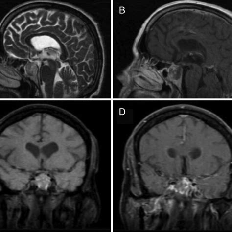 A T2 Weighted Sagittal Section Magnetic Resonance Imaging Mri Shows Download Scientific