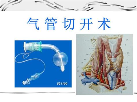 气管切开的位置 如何进行气管切开手术