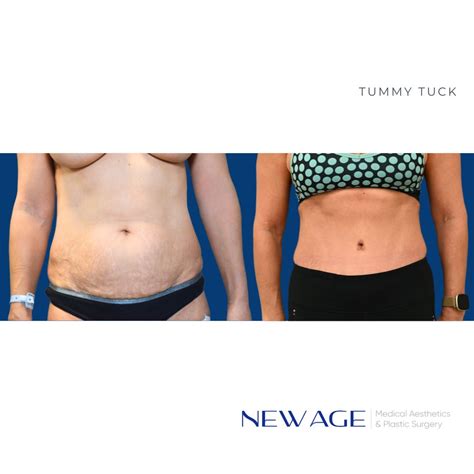 Tummy Tuck Ottawa New Age Medical Aesthetics And Plastic Surgery