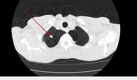 Computed Tomography Ct Chest Showing A Subcentimeter Spiculated Download Scientific Diagram