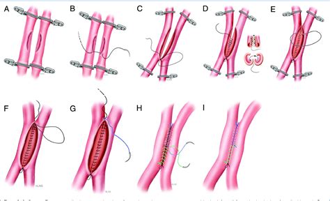 Figure From Intracranial In Situ Side To Side Microvascular