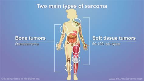 Pin on Animated Sarcoma Patient