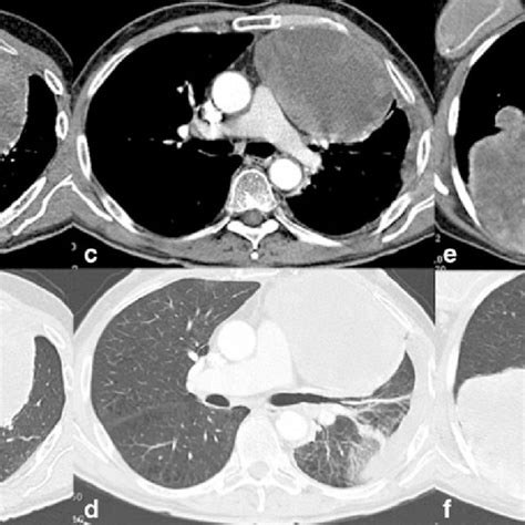 Ct Images Of Primary Intrathoracic Sarcomas Year Old Man A And B