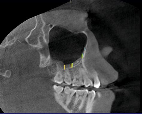 Sagittal Cbct Section Showing The Six Sites At Which The Mucosal